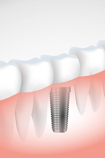 Making Dentures Step By Step Bingham IL 62011